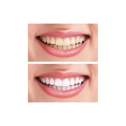 Blanqueador Dental Gel Tratamiento Dientes Blancos White