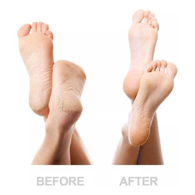 Quita Callos Eliminador Pedi Pro En Caja Excelente Calidad