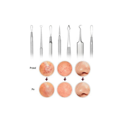 Kit Removedor De Puntos Negros Con Agujas Y Pinzas